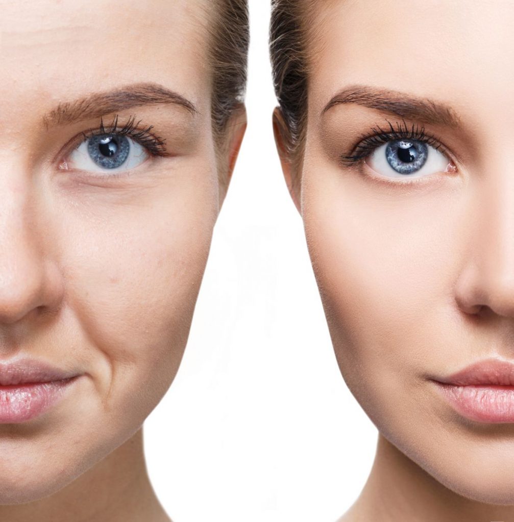 before and after skin tightening treatment