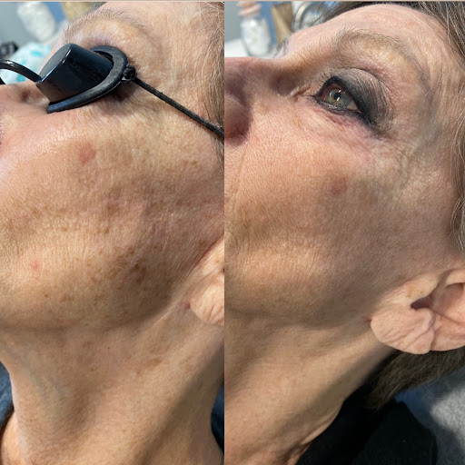 Before and after IPL treatment