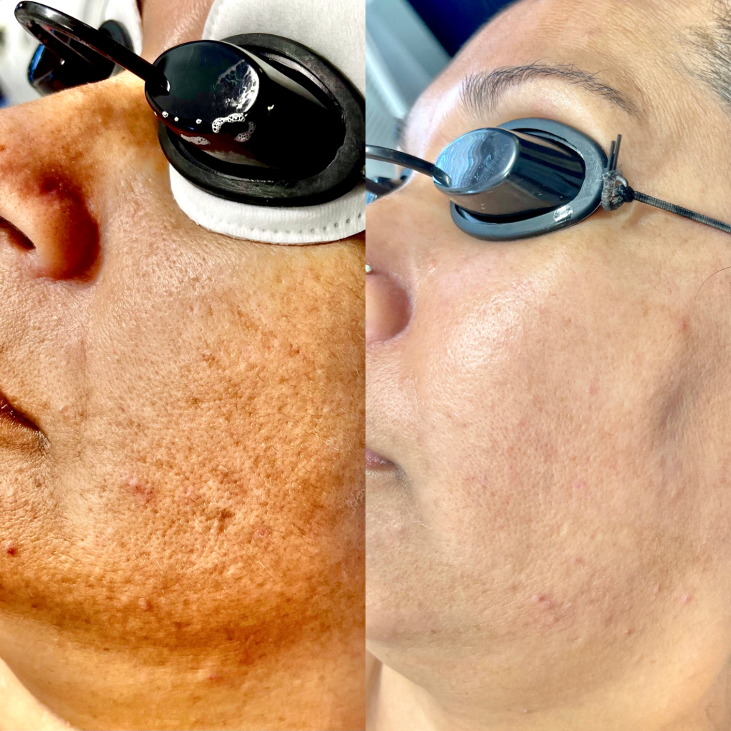 Carbon Laser Facial Before After